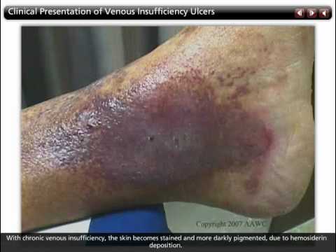 Characteristics of Venous Ulcers