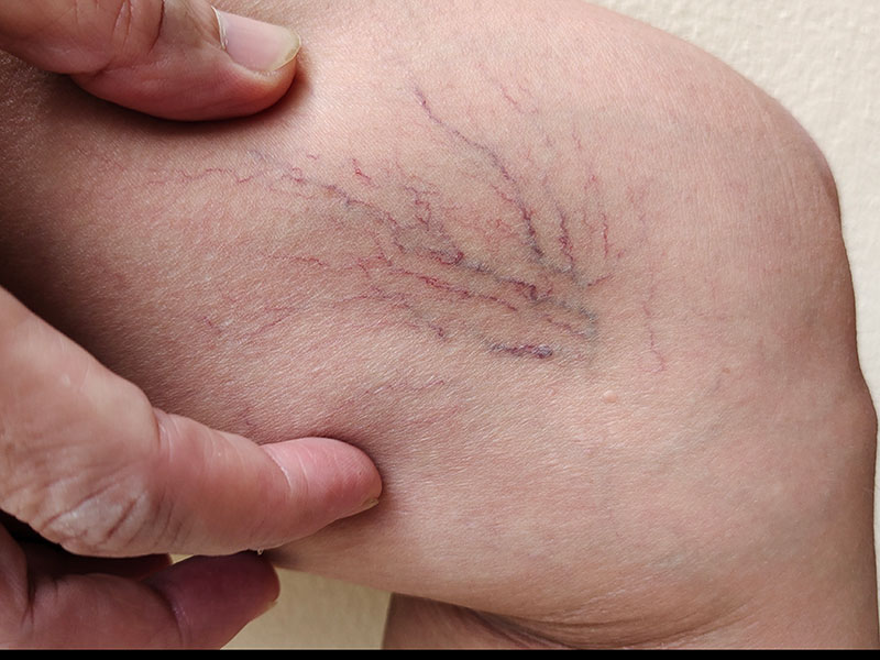 varicose veins on the leg