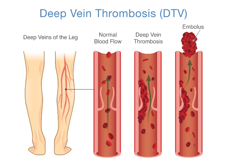 deep vein thrombosis illustrate