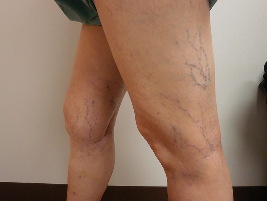 Vein disease on the leg