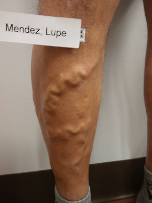 Vein disease on the leg