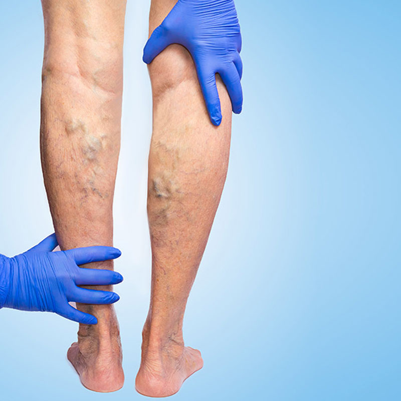 Venous Insufficiency Treatment in Houston, TX