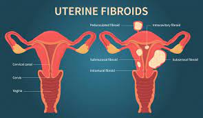 fibroid diagram