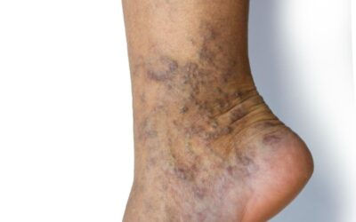 Actionable Tips for Men Suffering with Varicose Veins