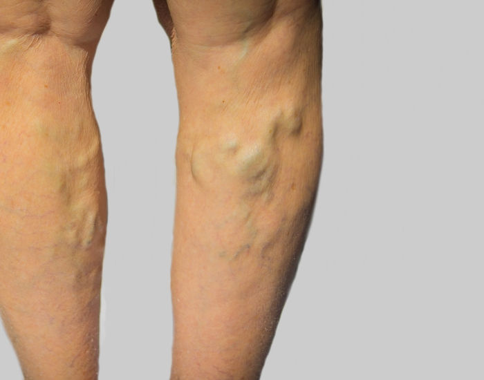 Clearing Up the Misconception: Why Are Veins Blue?