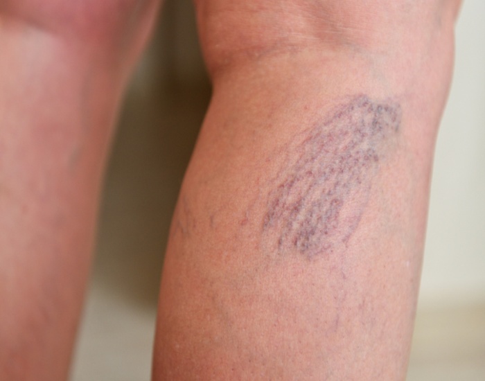 Varicose veins on female legs in Houston, TX