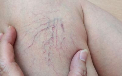 How Young Adults Get Varicose And Spider Veins