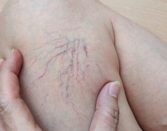 How Young Adults Get Varicose And Spider Veins
