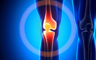 Genicular Artery Embolization: A Breakthrough In Pain Management of Arthritis Of The Knee Joint
