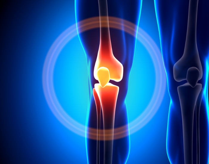 Genicular Artery Embolization: A Breakthrough In Pain Management of Arthritis Of The Knee Joint