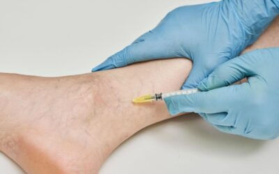 Understanding Varicose Veins: Causes, Symptoms, and Treatment Options
