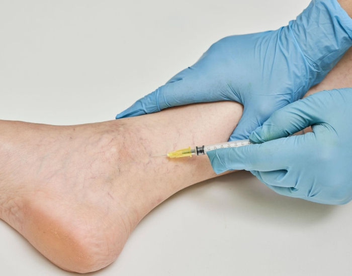 Understanding Varicose Veins: Causes, Symptoms, and Treatment Options