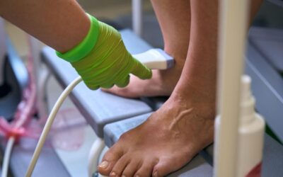 What are Varicose Veins and how to treat them