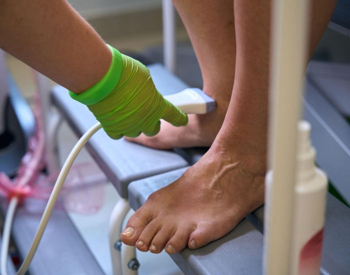 What are Varicose Veins and how to treat them