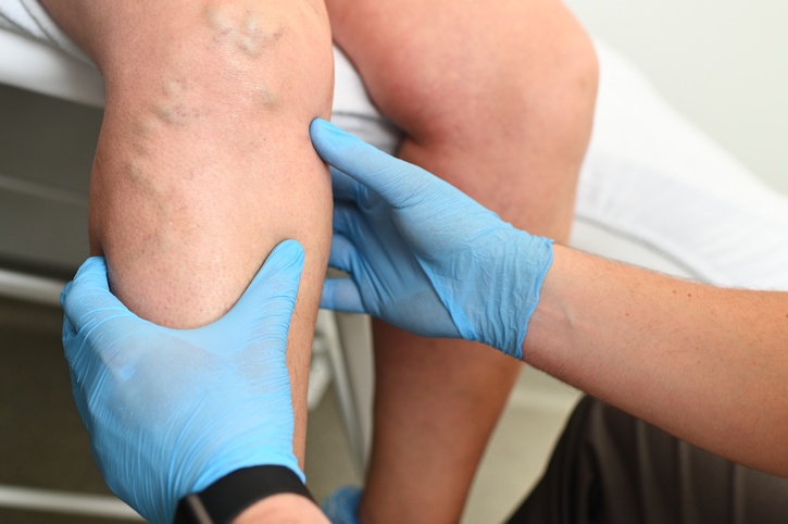 Varithena For Spider Veins in Houston, TX