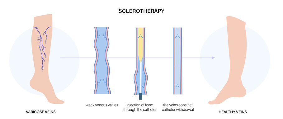 Close-up view of a leg affected by vein disease being treated with sclerotherapy