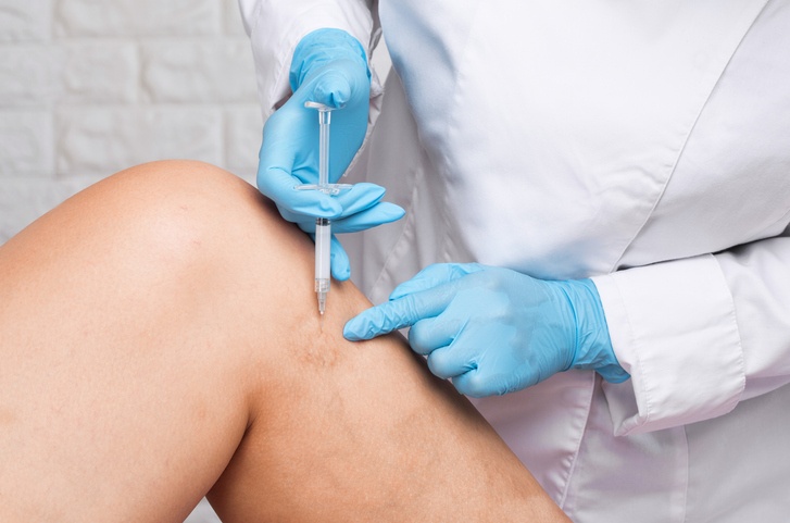 Ultrasound-Guided Foam Sclerotherapy in Houston, TX