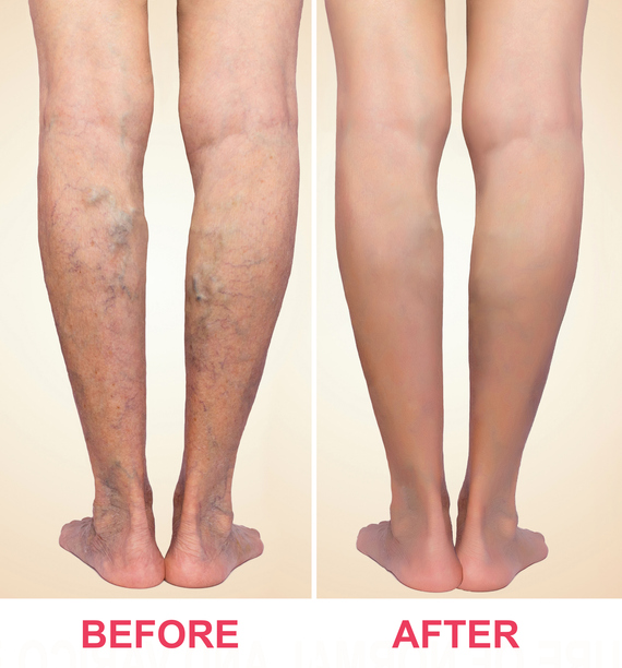 Treatment of varicose before and after.
