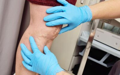 How to find a good vein doctor or vein specialist