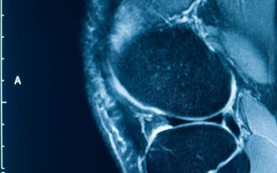 Role of MRI of Knee Before Genicular Artery Embolization