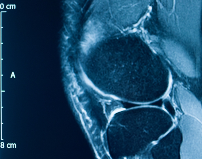 Role of MRI of Knee Before Genicular Artery Embolization