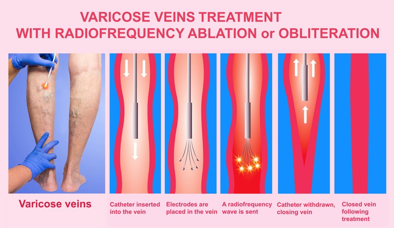 Varicose Veins Treatments with Radiofrequency Ablation (RFA) in Houston, TX