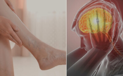 The Connection Between Stress and Varicose Veins, Houston, Texas
