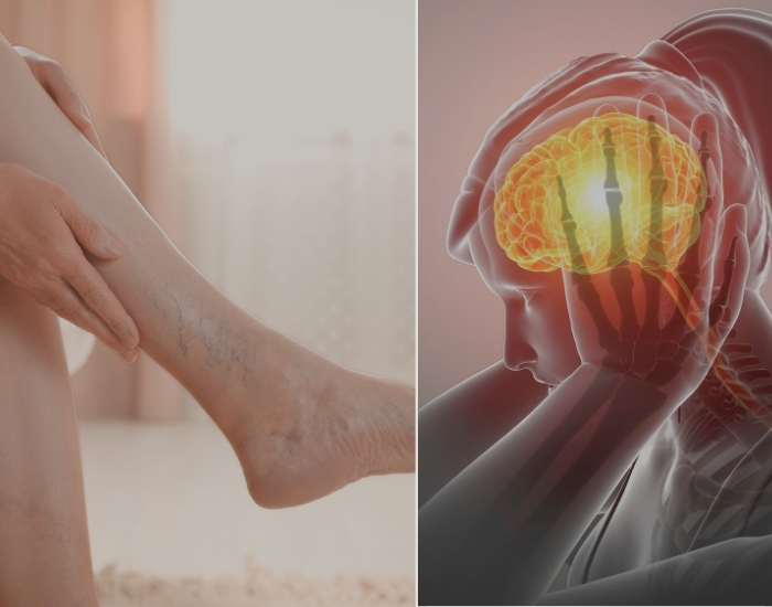 The Connection Between Stress and Varicose Veins, Houston, Texas
