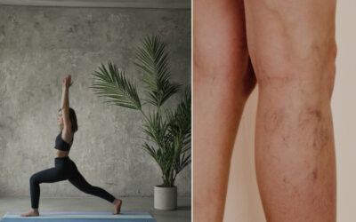 Yoga for Varicose Veins: Before and After Treatment