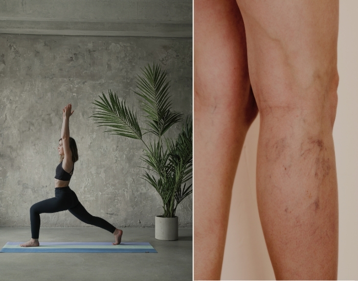 Yoga for Varicose Veins: Before and After Treatment