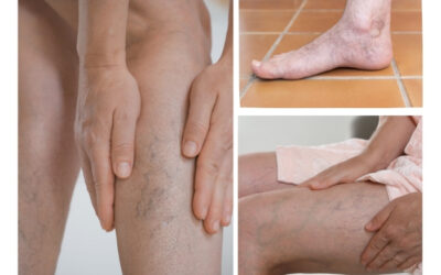 Deep Vein Thrombosis (DVT): Early Signs, Symptoms, and When to Seek a Specialist