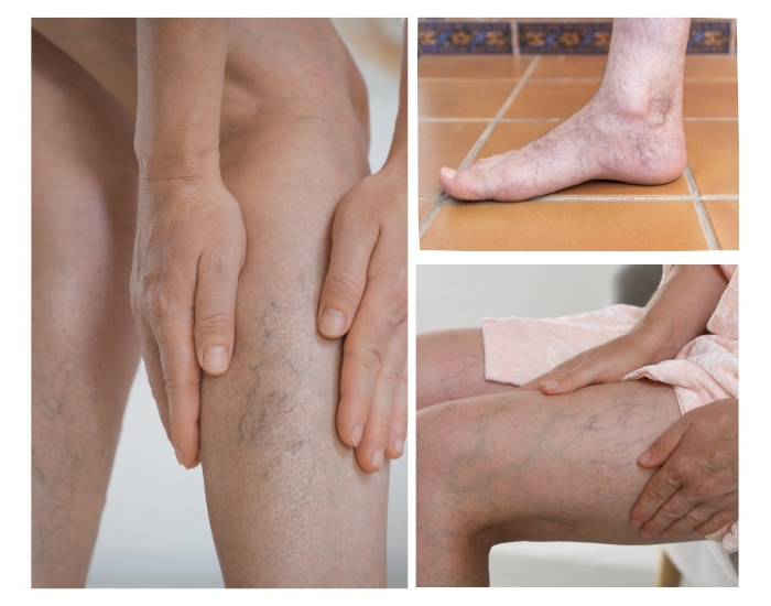 Deep Vein Thrombosis (DVT): Early Signs, Symptoms, and When to Seek a Specialist
