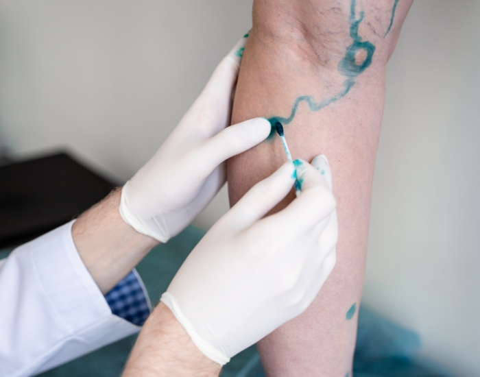 Ankles Swelling Every Evening: When to See an Evening Vein Specialist