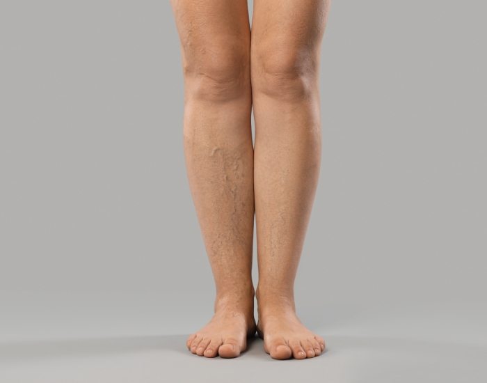 Heavy Feeling in the Legs: Causes, Symptoms & Solutions