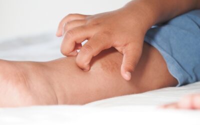 Can Itching Be a Symptom of Varicose Veins? Causes, Signs & Relief