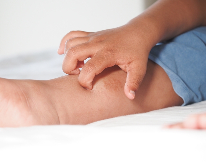 Can Itching Be a Symptom of Varicose Veins? Causes, Signs & Relief