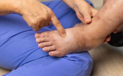 Persistent Swelling in Feet & Ankles: When to Consider a Vein Consultation
