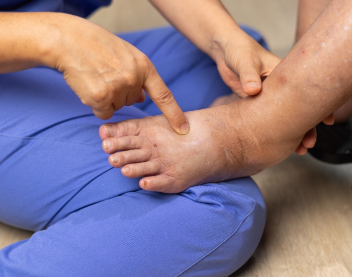 Persistent Swelling in Feet & Ankles: When to Consider a Vein Consultation