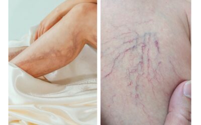 Symptoms of Spider Veins vs Varicose Veins