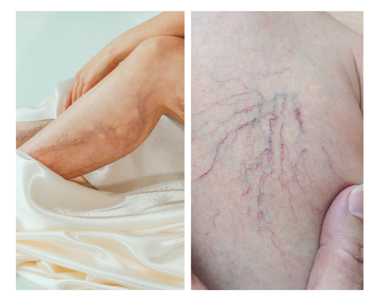 Symptoms of Spider Veins vs Varicose Veins – Houston Vein Specialist Guide