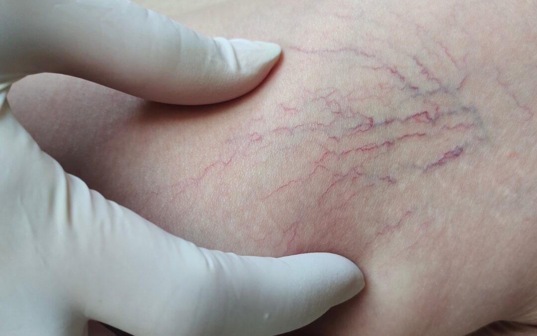 How to Treat Varicose Veins Without Surgery?