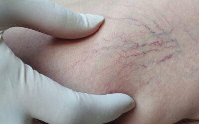 How to Treat Varicose Veins Without Surgery?