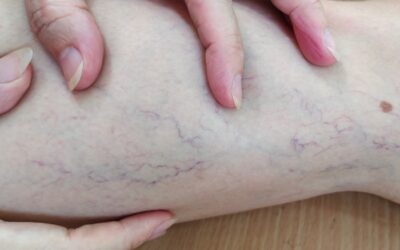 Leg Heaviness & Bulging Veins Houston: When to Seek Help