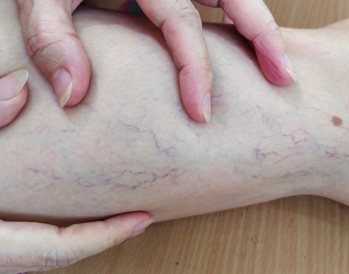 Leg Heaviness & Bulging Veins Houston: When to Seek Help