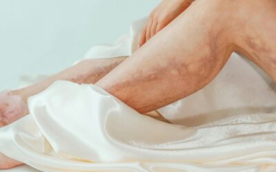 Itchy Legs with Visible Veins: When to Consider a Vascular Check