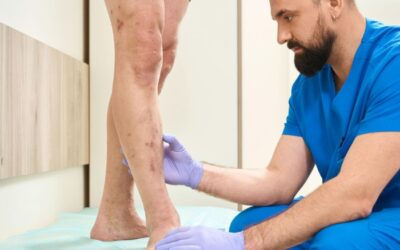 10 Effective Tips to Help Get Rid of Varicose Veins in the Legs
