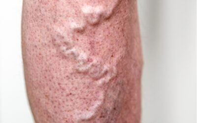 Bursting a Blood Vessel in the Legs or Feet: Causes, Symptoms, When to Worry, and Treatment Options