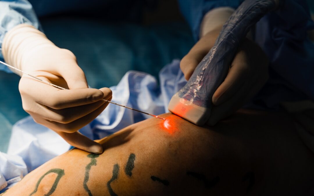 Is Vein Treatment Covered by Insurance?