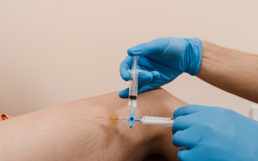 How Long is Recovery After Sclerotherapy?