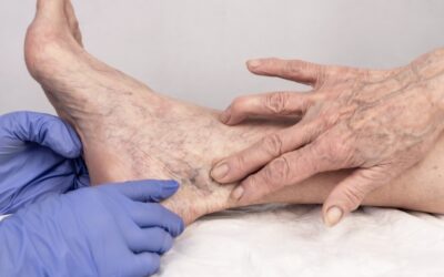 How Do I Know if My Veins Need Medical Treatment?